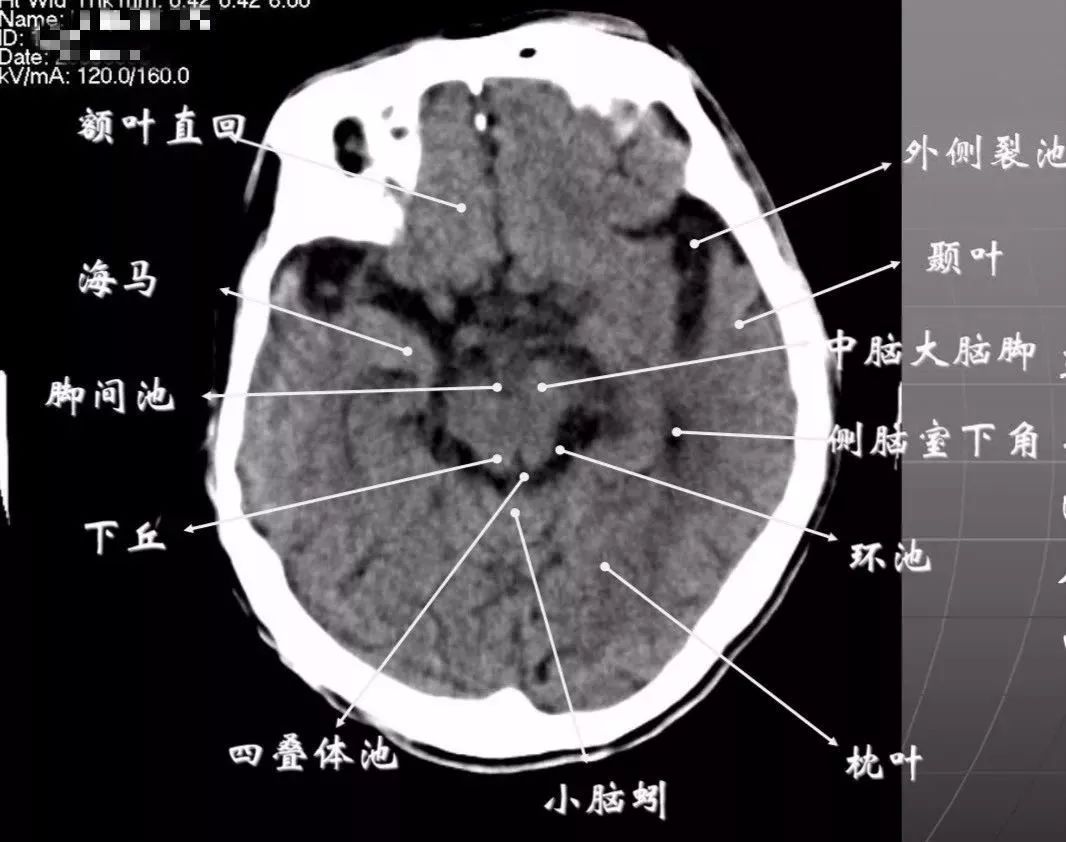 影像PPT - 头部CT读片详解-12 影像PPT - 头部CT读片详解-12