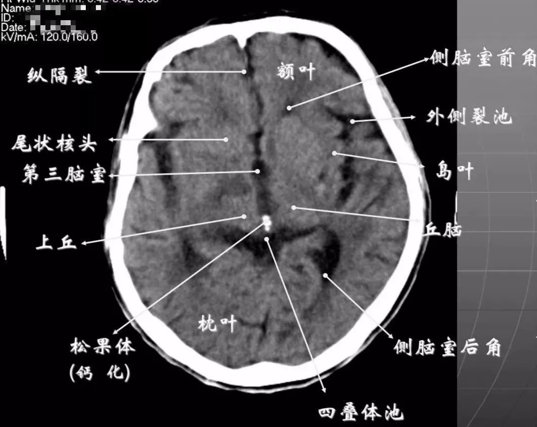 影像PPT - 头部CT读片详解-13 影像PPT - 头部CT读片详解-13