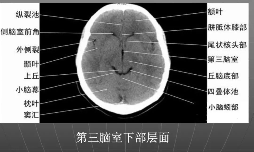 影像PPT - 头部CT读片详解-14 影像PPT - 头部CT读片详解-14