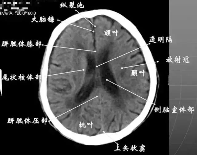 影像PPT - 头部CT读片详解-18 影像PPT - 头部CT读片详解-18
