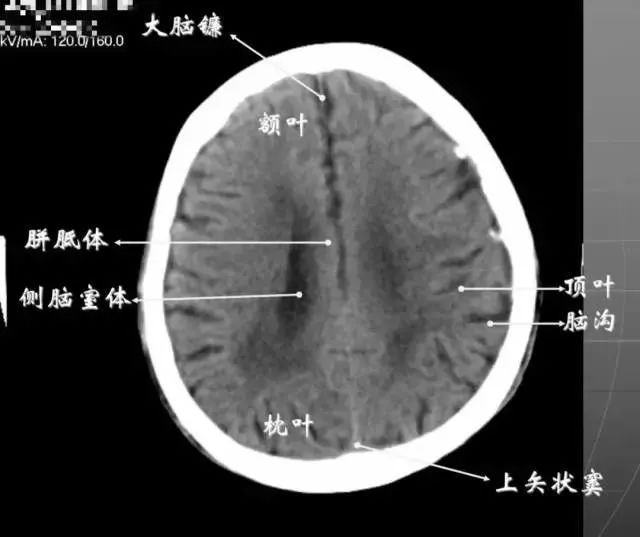 影像PPT - 头部CT读片详解-19 影像PPT - 头部CT读片详解-19