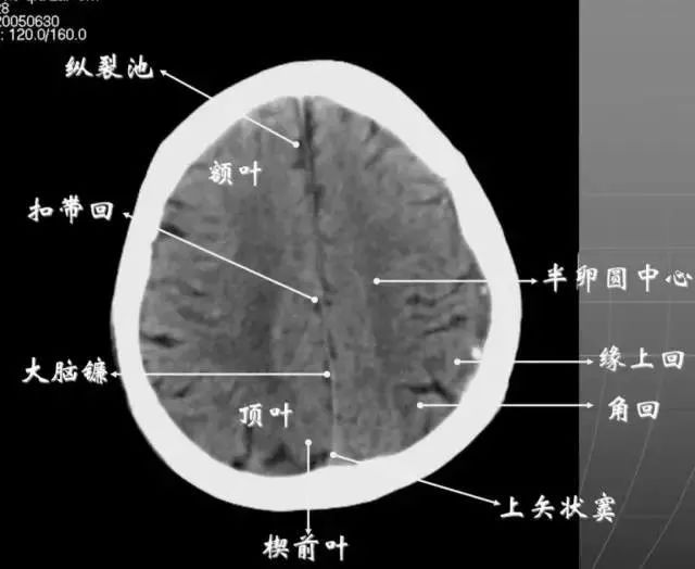 影像PPT - 头部CT读片详解-20 影像PPT - 头部CT读片详解-20