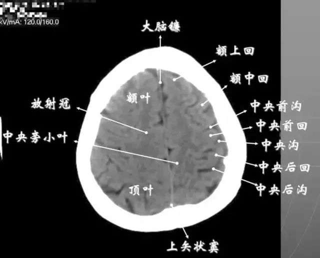 影像PPT - 头部CT读片详解-21 影像PPT - 头部CT读片详解-21