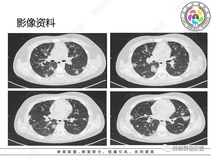 影像PPT - 【病例】血源性金黄色葡萄球菌性肺炎1例CT影像-5 影像PPT - 【病例】血源性金黄色葡萄球菌性肺炎1例CT影像-5