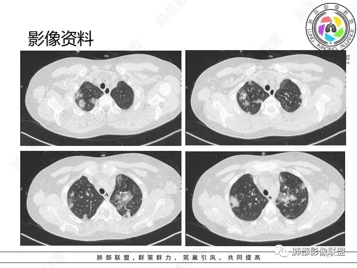 影像PPT - 【病例】血源性金黄色葡萄球菌性肺炎1例CT影像-3 影像PPT - 【病例】血源性金黄色葡萄球菌性肺炎1例CT影像-3