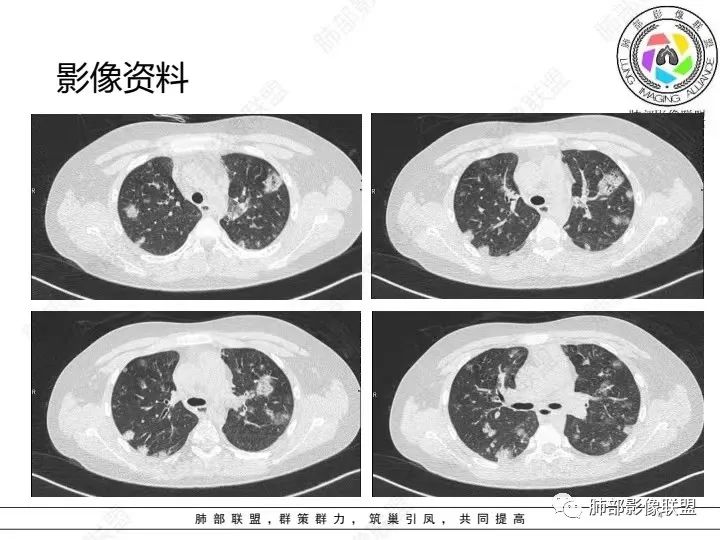 影像PPT - 【病例】血源性金黄色葡萄球菌性肺炎1例CT影像-4 影像PPT - 【病例】血源性金黄色葡萄球菌性肺炎1例CT影像-4