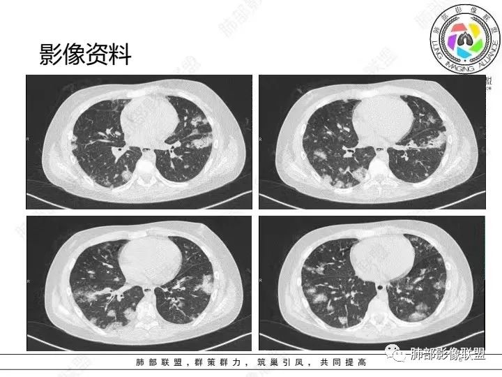 影像PPT - 【病例】血源性金黄色葡萄球菌性肺炎1例CT影像-6 影像PPT - 【病例】血源性金黄色葡萄球菌性肺炎1例CT影像-6