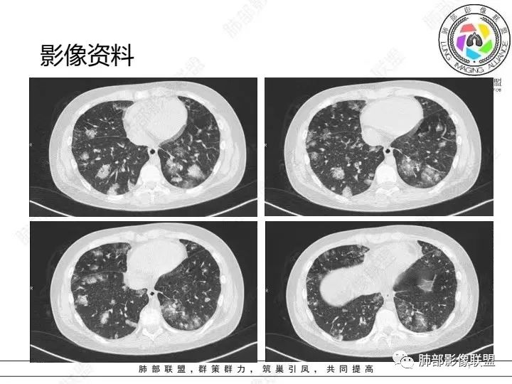 影像PPT - 【病例】血源性金黄色葡萄球菌性肺炎1例CT影像-7 影像PPT - 【病例】血源性金黄色葡萄球菌性肺炎1例CT影像-7
