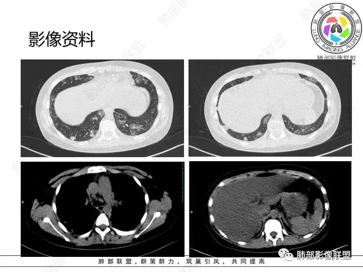 影像PPT - 【病例】血源性金黄色葡萄球菌性肺炎1例CT影像-8 影像PPT - 【病例】血源性金黄色葡萄球菌性肺炎1例CT影像-8