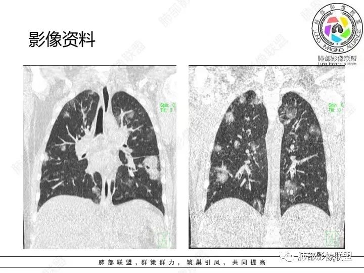 影像PPT - 【病例】血源性金黄色葡萄球菌性肺炎1例CT影像-9 影像PPT - 【病例】血源性金黄色葡萄球菌性肺炎1例CT影像-9