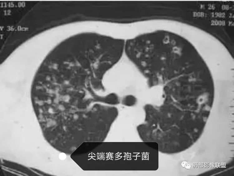 影像PPT - 【病例】血源性金黄色葡萄球菌性肺炎1例CT影像-13 影像PPT - 【病例】血源性金黄色葡萄球菌性肺炎1例CT影像-13