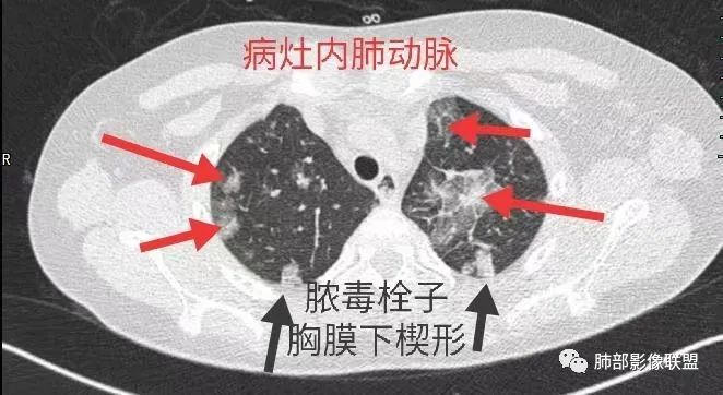 影像PPT - 【病例】血源性金黄色葡萄球菌性肺炎1例CT影像-15 影像PPT - 【病例】血源性金黄色葡萄球菌性肺炎1例CT影像-15