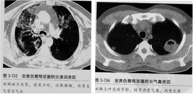 影像PPT - 【病例】血源性金黄色葡萄球菌性肺炎1例CT影像-32 影像PPT - 【病例】血源性金黄色葡萄球菌性肺炎1例CT影像-32