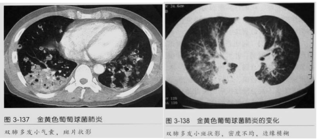 影像PPT - 【病例】血源性金黄色葡萄球菌性肺炎1例CT影像-33 影像PPT - 【病例】血源性金黄色葡萄球菌性肺炎1例CT影像-33