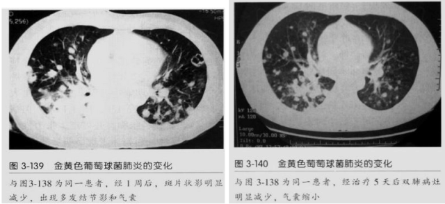 影像PPT - 【病例】血源性金黄色葡萄球菌性肺炎1例CT影像-34 影像PPT - 【病例】血源性金黄色葡萄球菌性肺炎1例CT影像-34
