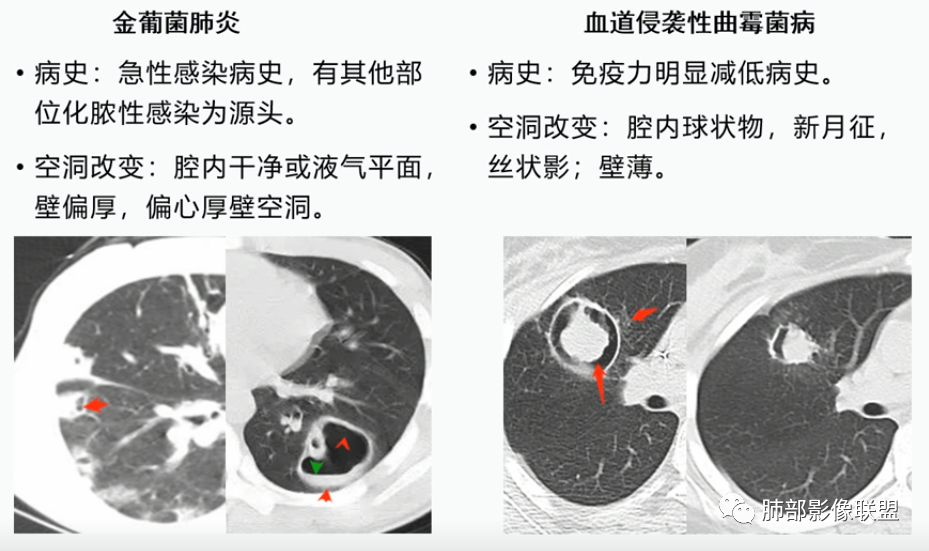 影像PPT - 【病例】血源性金黄色葡萄球菌性肺炎1例CT影像-42 影像PPT - 【病例】血源性金黄色葡萄球菌性肺炎1例CT影像-42