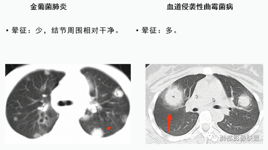 影像PPT - 【病例】血源性金黄色葡萄球菌性肺炎1例CT影像-43 影像PPT - 【病例】血源性金黄色葡萄球菌性肺炎1例CT影像-43