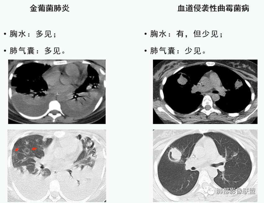 影像PPT - 【病例】血源性金黄色葡萄球菌性肺炎1例CT影像-44 影像PPT - 【病例】血源性金黄色葡萄球菌性肺炎1例CT影像-44