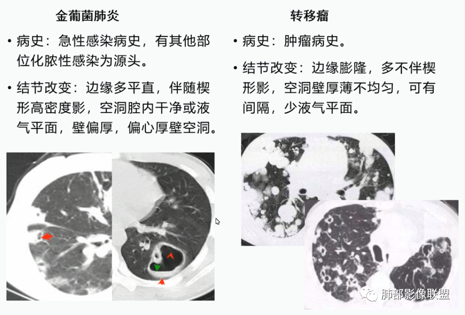 影像PPT - 【病例】血源性金黄色葡萄球菌性肺炎1例CT影像-45 影像PPT - 【病例】血源性金黄色葡萄球菌性肺炎1例CT影像-45