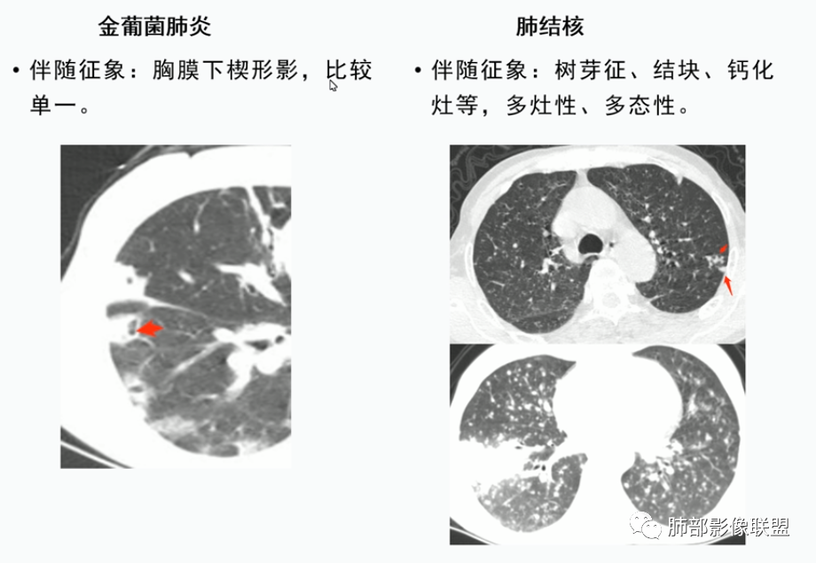 影像PPT - 【病例】血源性金黄色葡萄球菌性肺炎1例CT影像-47 影像PPT - 【病例】血源性金黄色葡萄球菌性肺炎1例CT影像-47