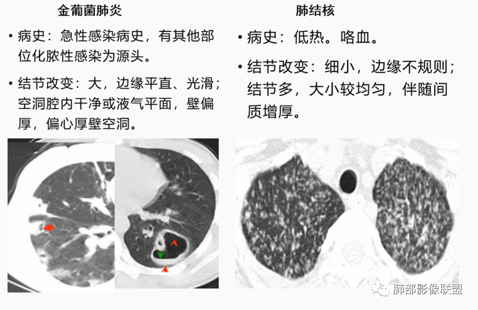 影像PPT - 【病例】血源性金黄色葡萄球菌性肺炎1例CT影像-46 影像PPT - 【病例】血源性金黄色葡萄球菌性肺炎1例CT影像-46