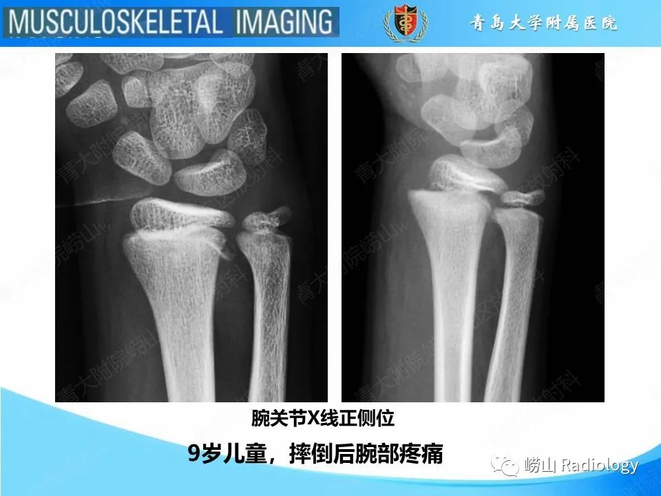 影像PPT - 【PPT】索尔特骨折-2