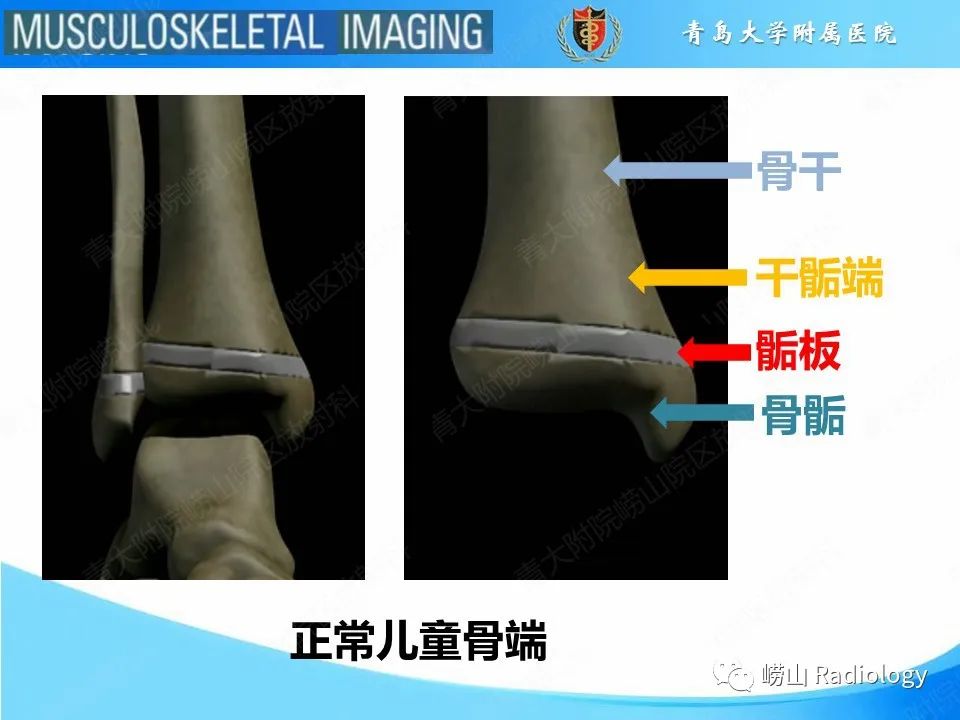 影像PPT - 【PPT】索尔特骨折-4