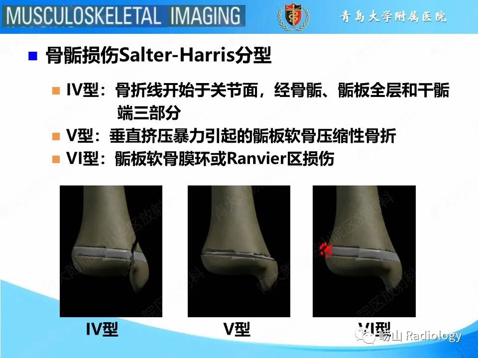影像PPT - 【PPT】索尔特骨折-6