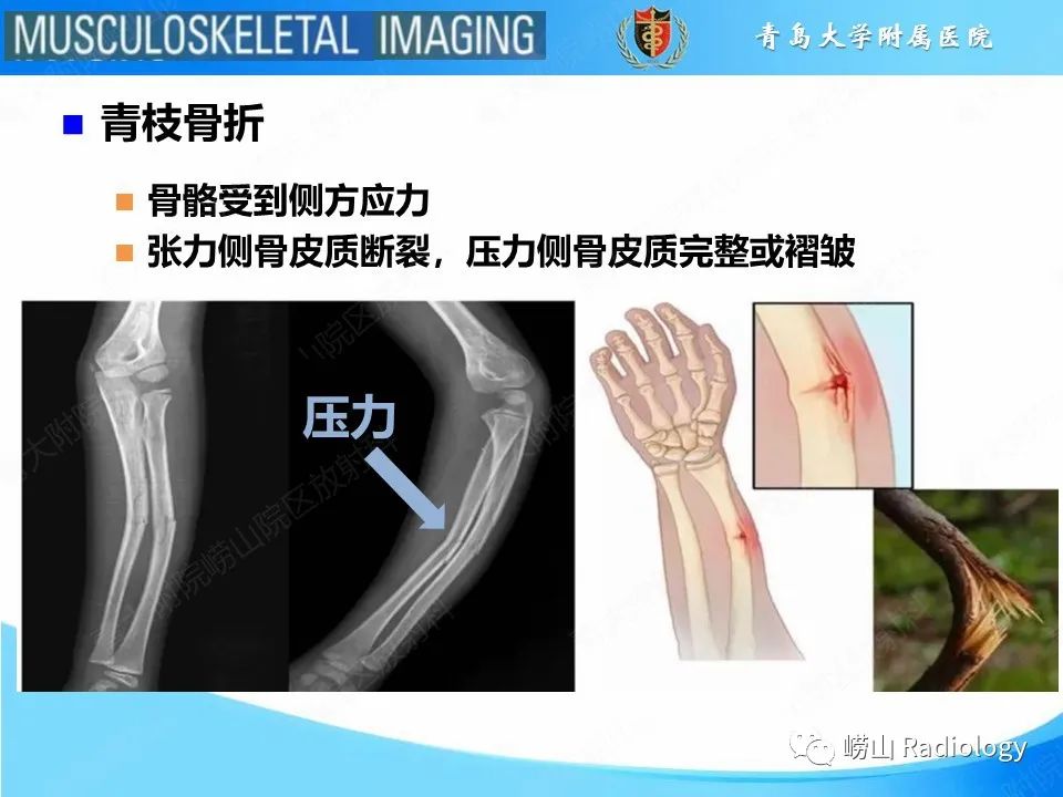 影像PPT - 【PPT】索尔特骨折-11