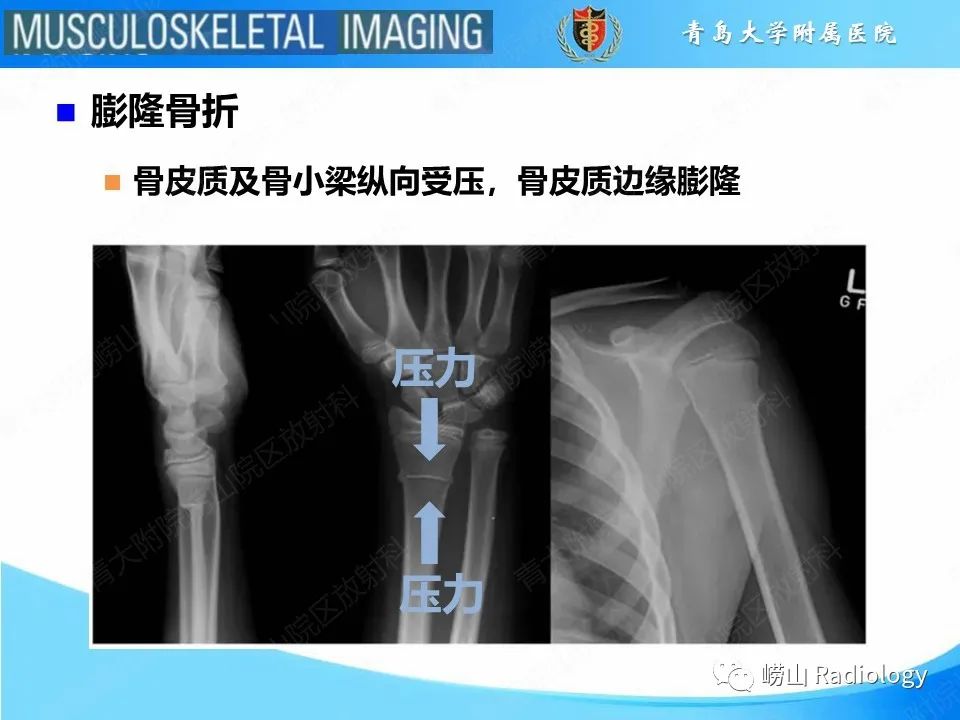 影像PPT - 【PPT】索尔特骨折-12