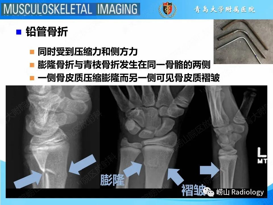 影像PPT - 【PPT】索尔特骨折-13