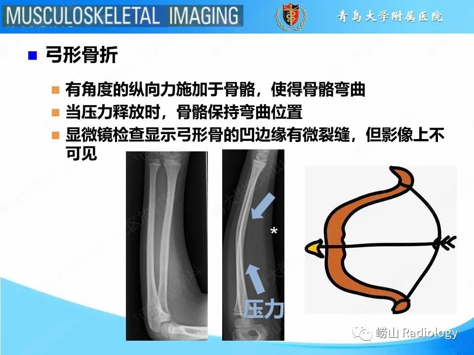 影像PPT - 【PPT】索尔特骨折-14