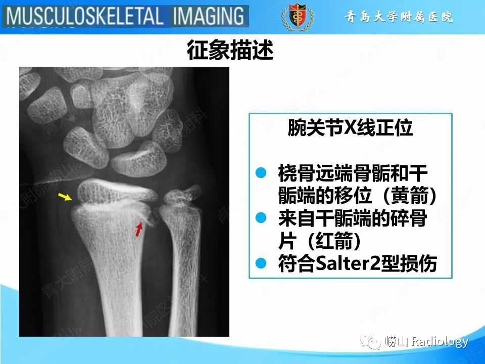 影像PPT - 【PPT】索尔特骨折-19