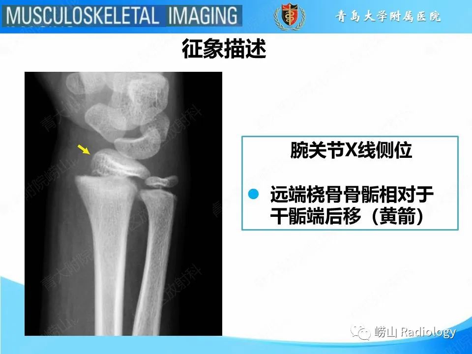 影像PPT - 【PPT】索尔特骨折-20