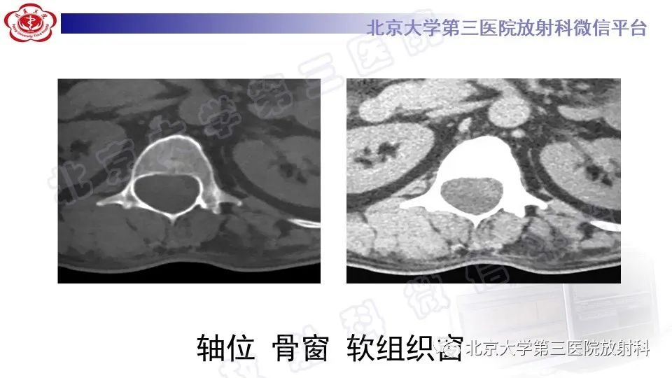 影像PPT - 【PPT】椎管内脊膜囊肿-4
