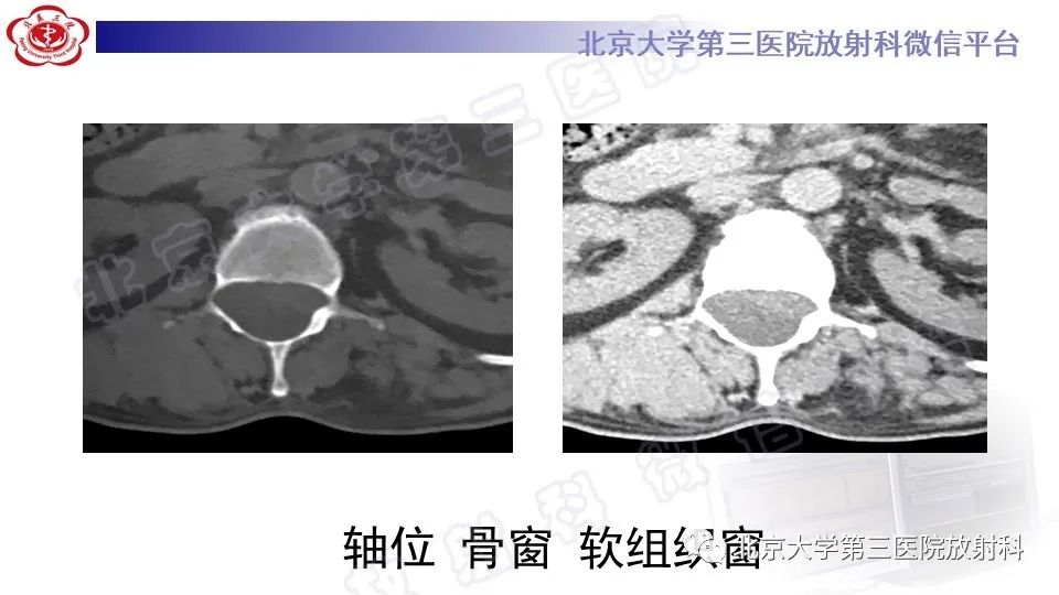影像PPT - 【PPT】椎管内脊膜囊肿-3