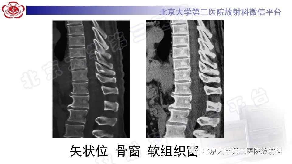 影像PPT - 【PPT】椎管内脊膜囊肿-5