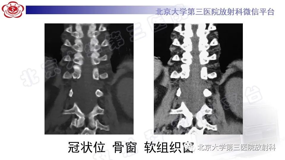 影像PPT - 【PPT】椎管内脊膜囊肿-6