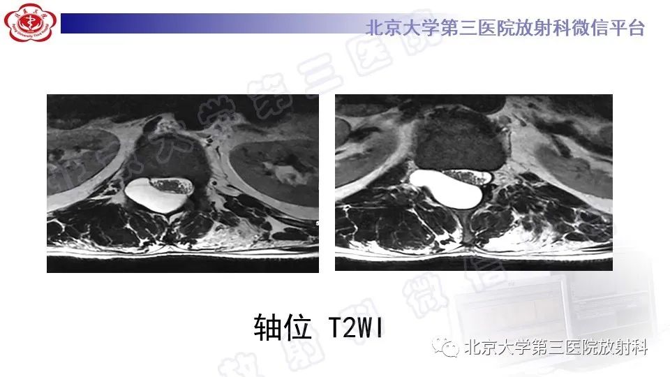 影像PPT - 【PPT】椎管内脊膜囊肿-7