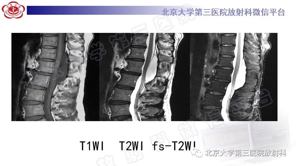 影像PPT - 【PPT】椎管内脊膜囊肿-8