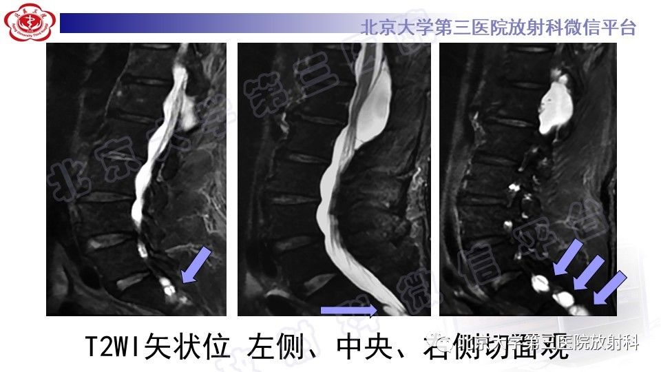 影像PPT - 【PPT】椎管内脊膜囊肿-9
