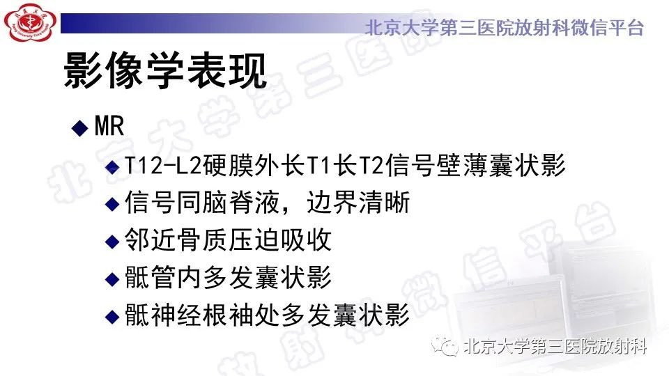 影像PPT - 【PPT】椎管内脊膜囊肿-11