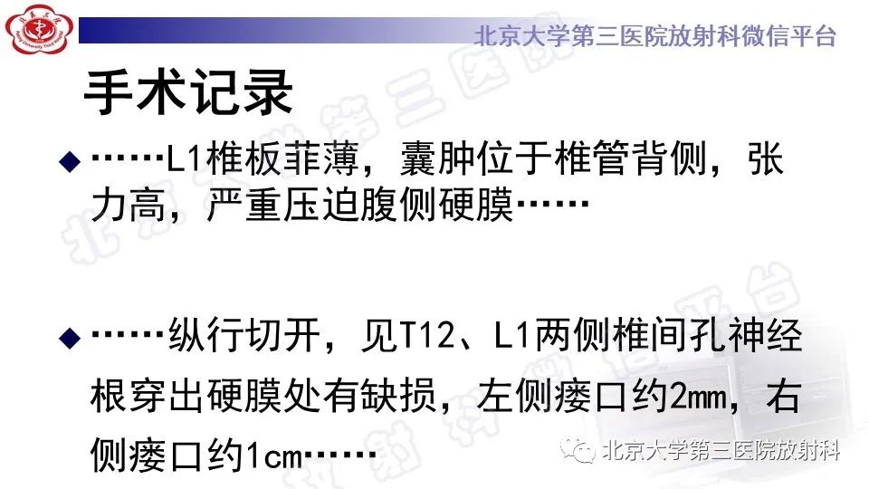 影像PPT - 【PPT】椎管内脊膜囊肿-12