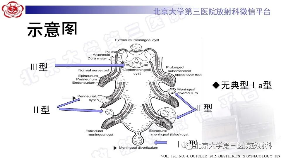影像PPT - 【PPT】椎管内脊膜囊肿-18