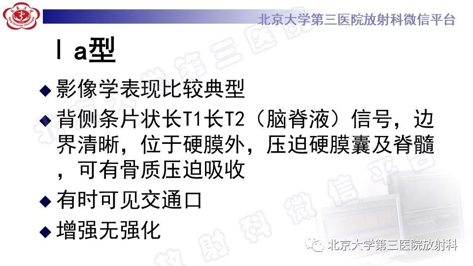 影像PPT - 【PPT】椎管内脊膜囊肿-21