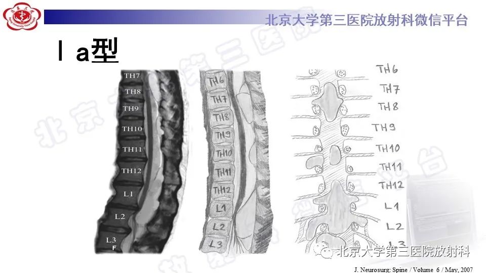 影像PPT - 【PPT】椎管内脊膜囊肿-22