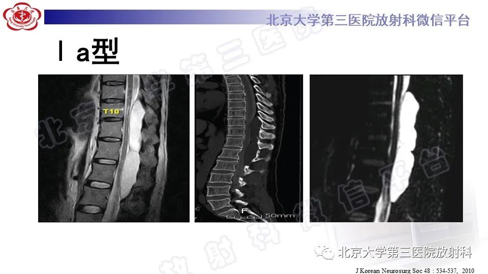 影像PPT - 【PPT】椎管内脊膜囊肿-23