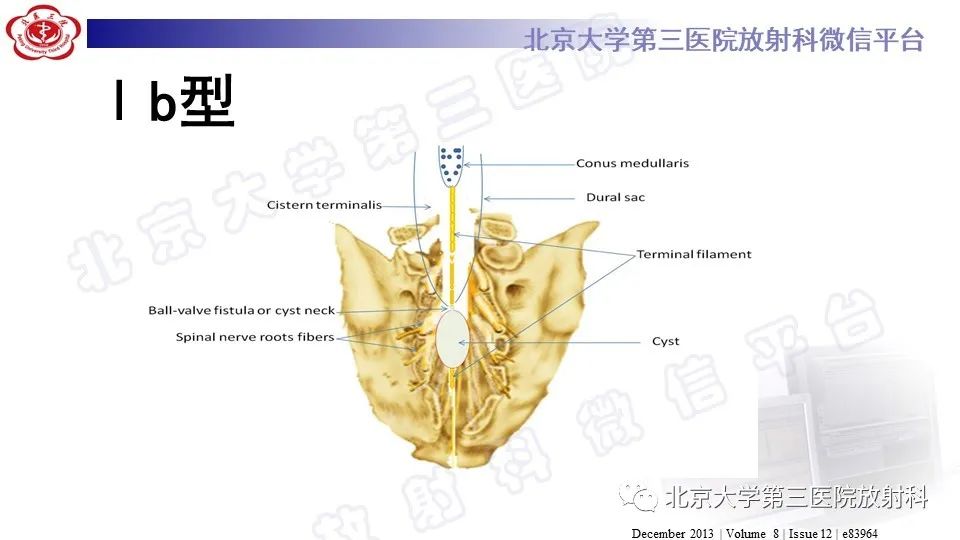 影像PPT - 【PPT】椎管内脊膜囊肿-25