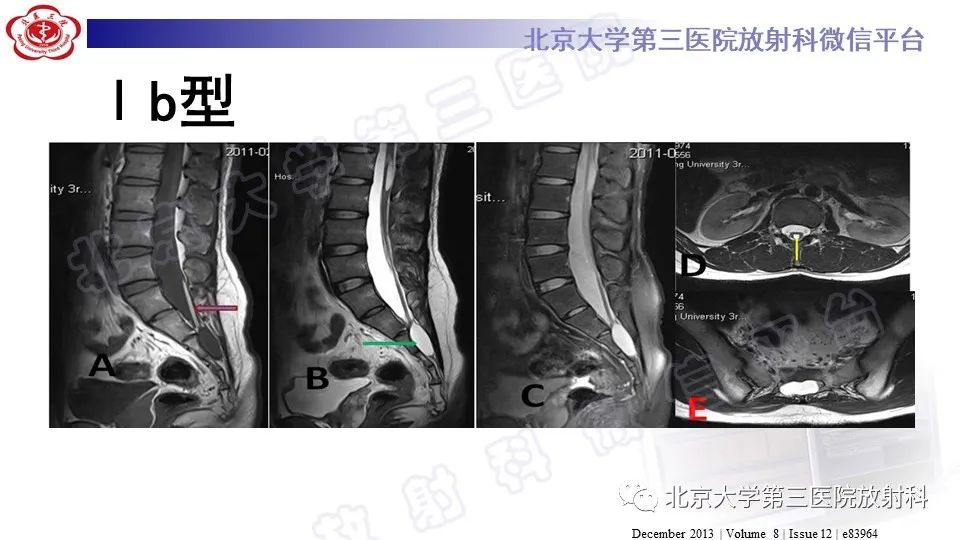 影像PPT - 【PPT】椎管内脊膜囊肿-26