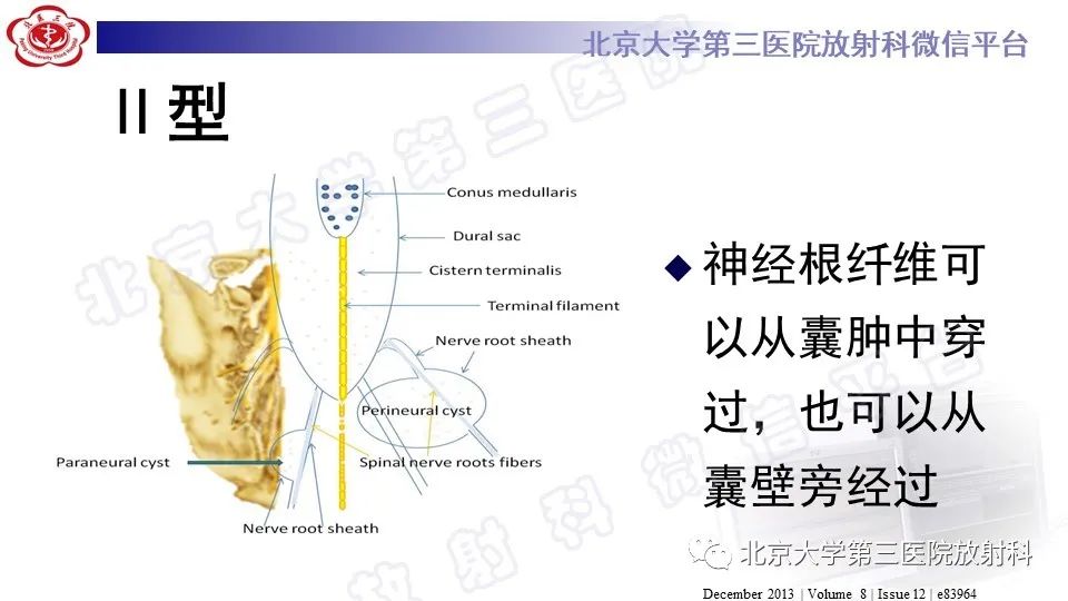 影像PPT - 【PPT】椎管内脊膜囊肿-28
